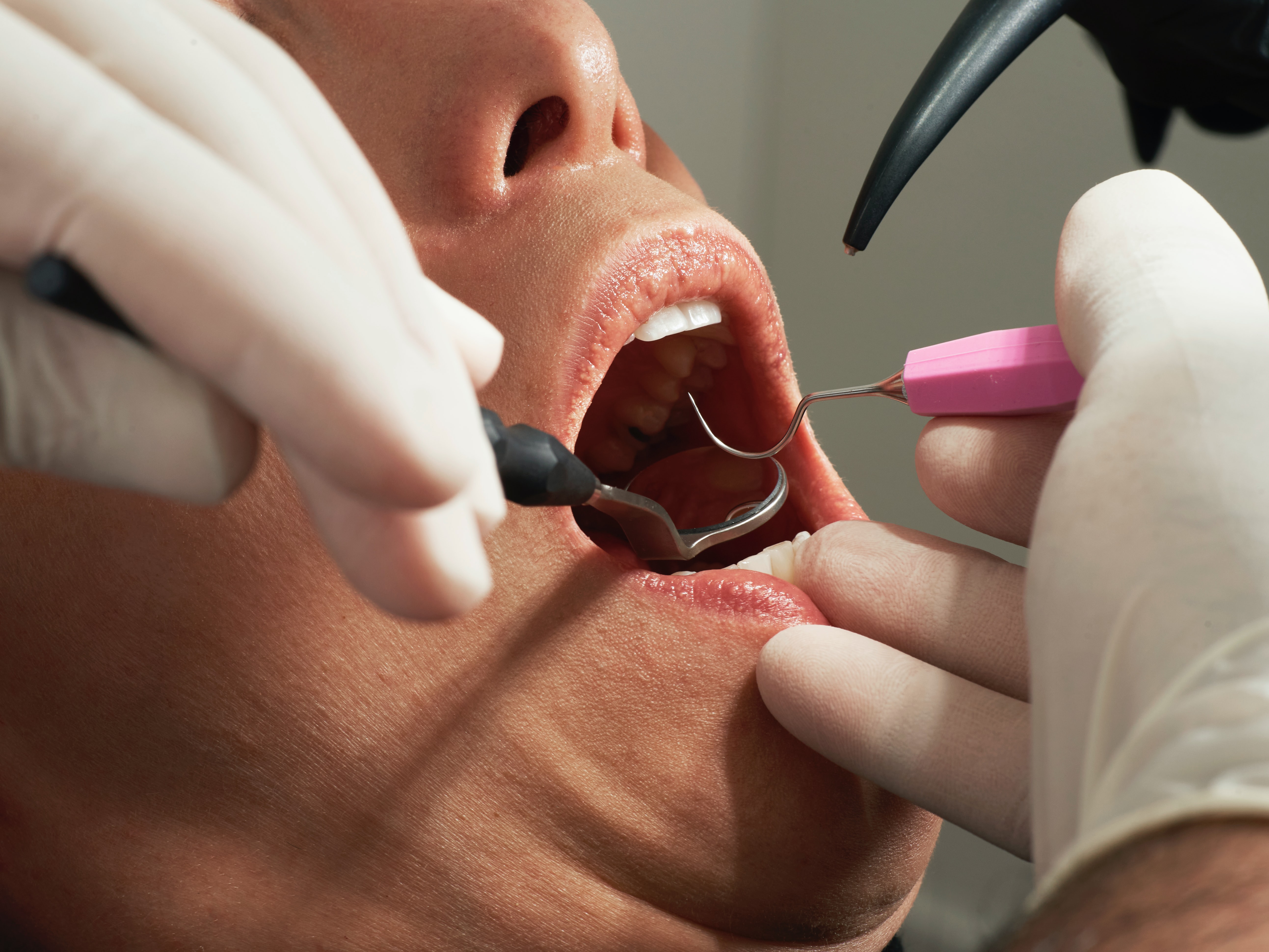 I tumori del cavo orale: prevenzione e diagnosi